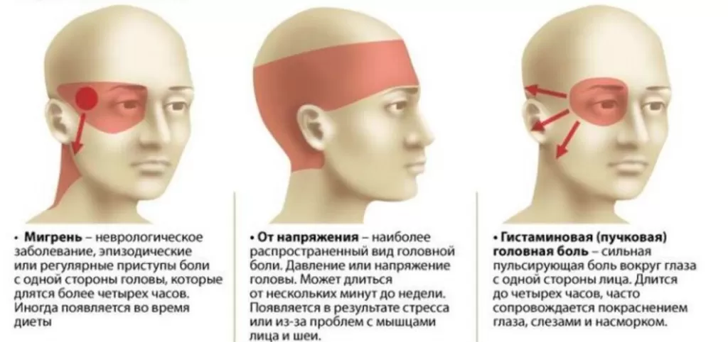 Кластерные головные боли